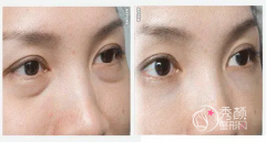 上海九院做超声波去眼袋果怎么样？大概需要多少钱？