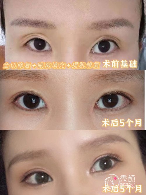 郑州孟明星双眼皮修复技术怎么样？附孟明星双眼皮修复案例
