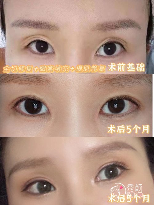 郑州孟明星双眼皮修复技术怎么样，靠谱吗？附孟明星修复案例