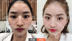 张笑天磨骨怎么样，张笑天颧骨内推真人案例曝光