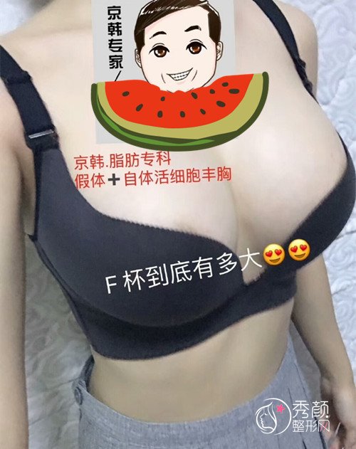 乔爱军做自体脂肪丰胸怎么样,附乔爱军隆胸案例反馈。