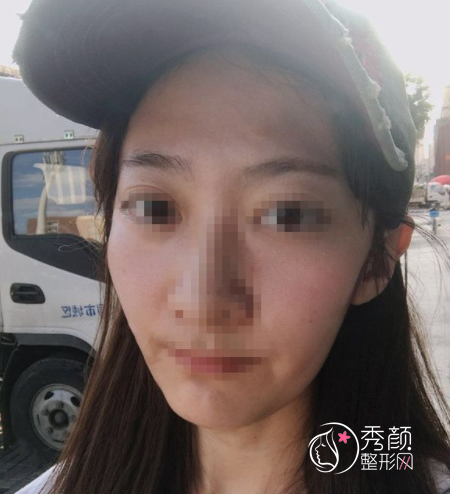 上海伯思立顾建成脂肪填充怎么样,有没有失败案例？附面部填充案例分享。