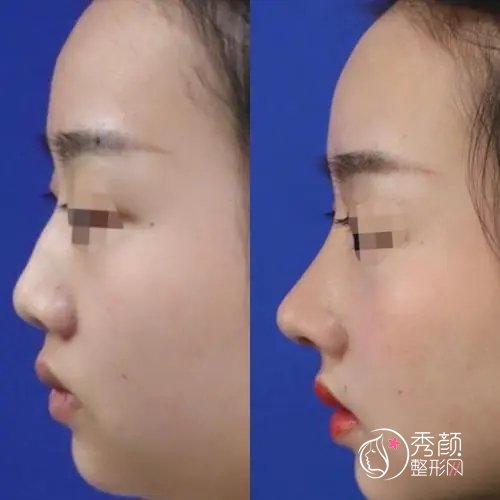 上海九院做鼻子修复戴传昌、祝联、魏皎怎么样，哪个技术更好？