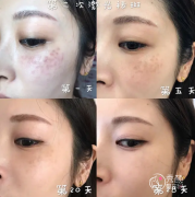 蚌埠哪家医院激光祛斑好？