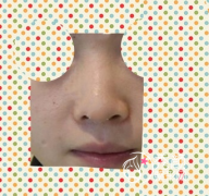 昆山达拉斯刘波80000做的隆鼻手术，全肋107天和大家分享一下。