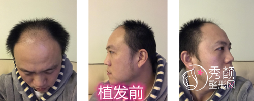 上海华美黄兴勇植发怎么样,多少钱？附黄兴勇植发案例