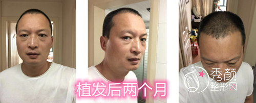 上海华美黄兴勇植发怎么样,多少钱？附黄兴勇植发案例