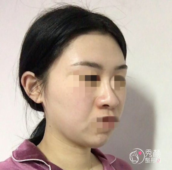 北医三院安阳隆鼻案例分享|安阳隆鼻技术怎么样及审美