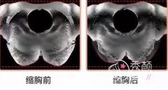 <b>缩胸手术一般多少钱?缩胸手术术前术后真人案例对比</b>