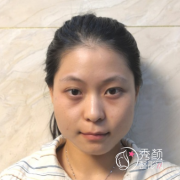 姜民范磨骨怎么样，不知不觉找姜民范磨骨手术已经三个月了