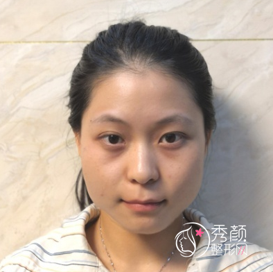 姜民范磨骨怎么样，不知不觉找姜民范磨骨手术已经三个月了