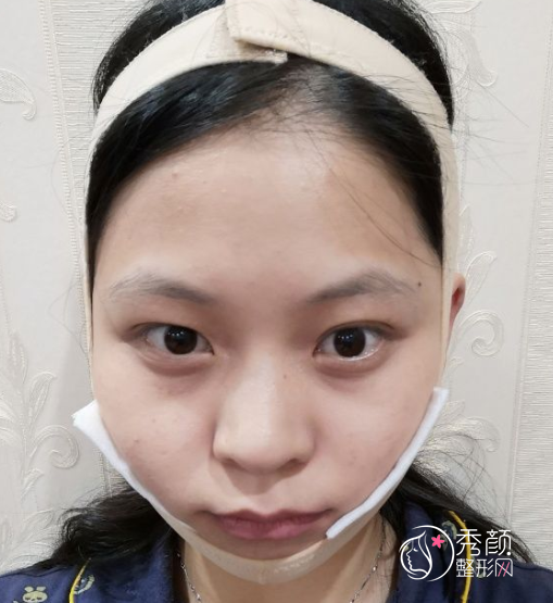 姜民范磨骨怎么样，不知不觉找姜民范磨骨手术已经三个月了