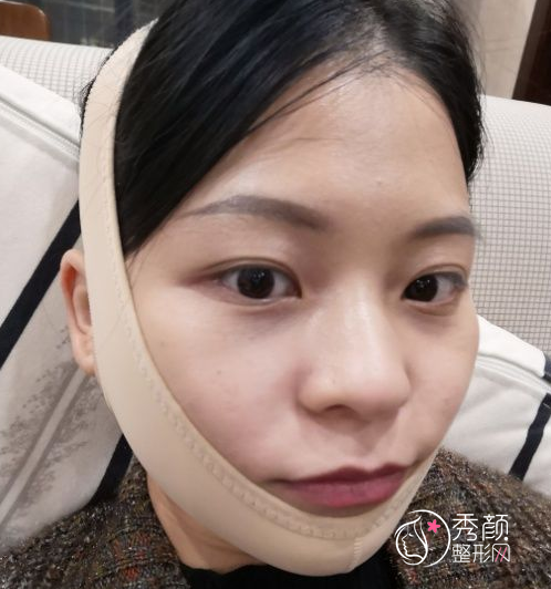 姜民范磨骨怎么样，不知不觉找姜民范磨骨手术已经三个月了