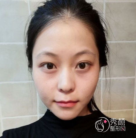 姜民范磨骨怎么样，不知不觉找姜民范磨骨手术已经三个月了