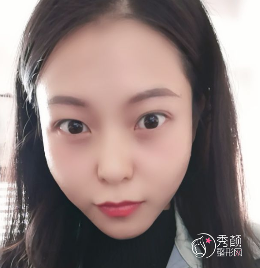 姜民范磨骨怎么样，不知不觉找姜民范磨骨手术已经三个月了