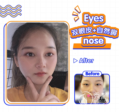 长沙协雅邹笑寒做鼻子怎么样|附双眼皮隆鼻案例