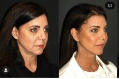 2022国内十大做拉皮手术较有名的医生排行榜