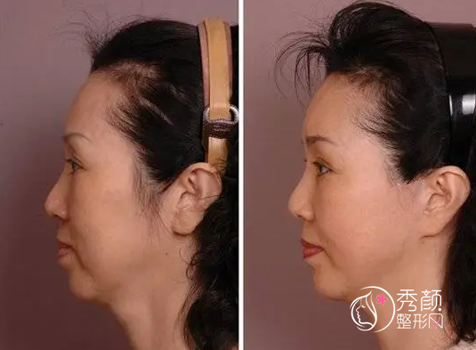 上海伯思立倪锋医生拉皮怎样？做拉皮手术大概需要多少钱？