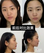 <b>超声炮vs到底哪个面部提升效果好？附真人案例对比</b>