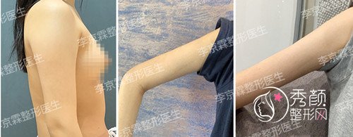 北京悦然医疗美容李京霖吸脂怎么样,有没有失败案例?