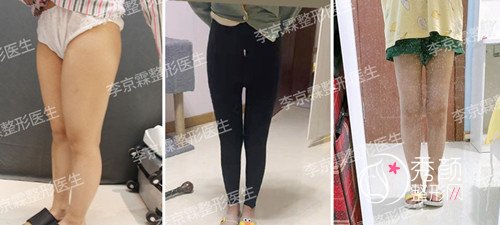 北京悦然医疗美容李京霖吸脂怎么样,有没有失败案例?