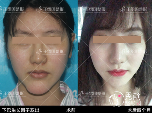 取奥美定李方奇、王绍国、李奇军和邓正军哪个好?技术、价格对比!