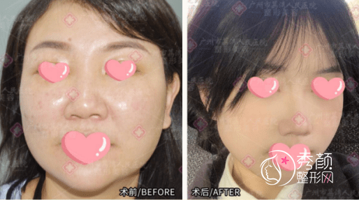 取奥美定李方奇、王绍国、李奇军和邓正军哪个好?技术、价格对比!