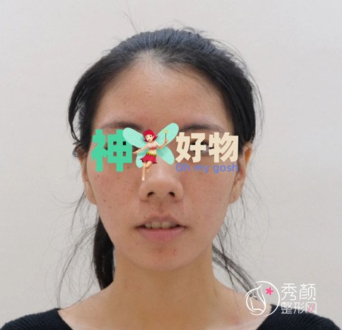 重庆美仑美奂杜亚旭隆鼻手术做得怎么样，附杜亚旭隆鼻案例参考