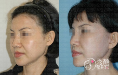 <b>筋膜悬吊术和面部埋线提升都是拉皮手术吗，有什么区别？</b>