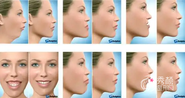 广州广大何锦泉做正颌手术怎么样，技术靠谱吗？