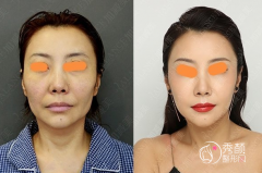 北京做拉皮手术哪家医院好？加减美、十优、华韩哪个好？