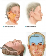 <b>拉皮手术副作用有哪些?太可怕了</b>