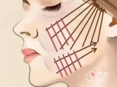 <b>45岁做还是拉皮手术好？</b>