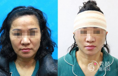 北京加减美穆宝安拉皮技术怎么样，附面部拉皮手术案例