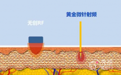 黄金微针和黄金射频微针哪个好，各有什么优点缺点？