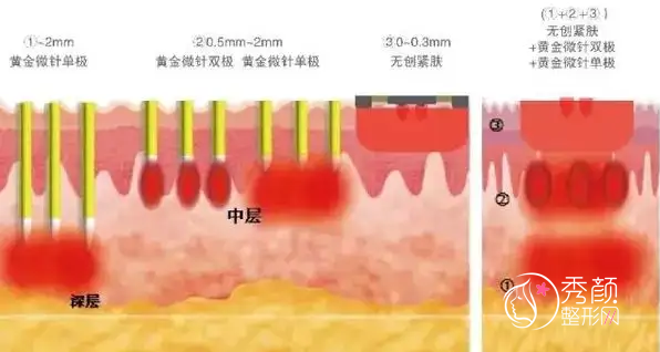 黄金微针和黄金射频微针哪个好，各有什么优点缺点？