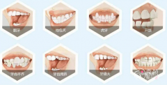 牙齿矫正必看：32款主流牙套品牌价格表参考