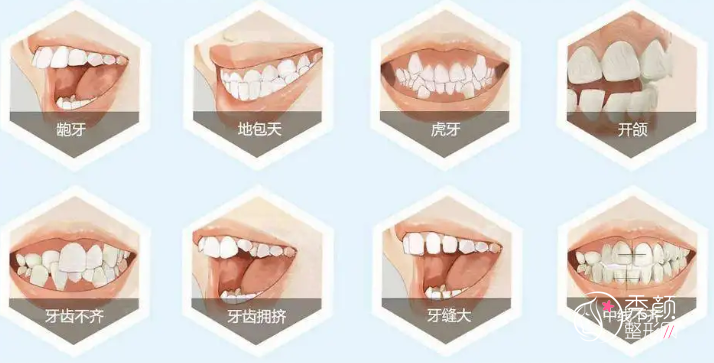 牙齿矫正必看：32款主流牙套品牌价格表参考