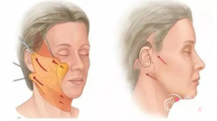 沈阳杏林做拉皮手术效果怎么样？附杏林整形面部提升价格表