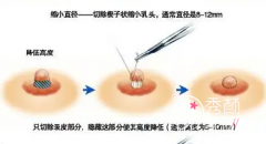 <b>上海第九人民医院缩胸手术好不好?徐华|余力|王涛手术价格</b>