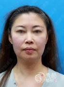 黄寅守面部提升案例，看看我花了10来万的拉皮手术做得值吗？
