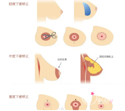 上海第九人民医院做乳房下垂矫正怎么样，大概需要多少钱？