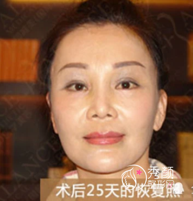 北京加减美穆宝安拉皮案例，术后减龄20岁。