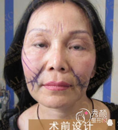 北京加减美穆宝安拉皮案例，术后减龄20岁。