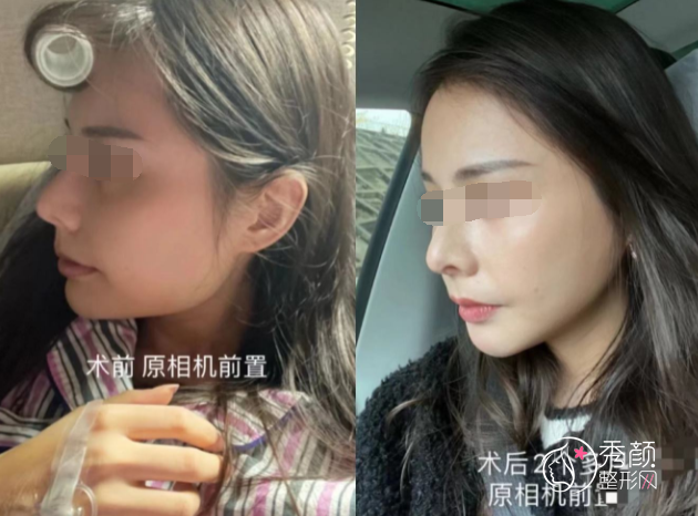 张立天和罗恩磨骨谁做出来的效果更好?技术口碑审美案例对比