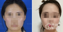 <b>张立天和罗恩磨骨谁做出来的效果更好？技术口碑审美案例对比</b>