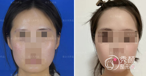 张立天和罗恩磨骨谁做出来的效果更好?技术口碑审美案例对比