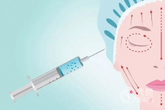 上海九院打玻尿酸多少钱一支，上海九院玻尿酸注射收费指南