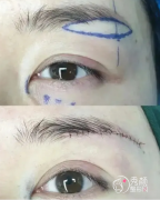 <b>提眉术有哪些方法？哪些人适合做提眉？</b>