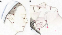 <b>什么是筋膜悬吊手术？面部抗衰效果好吗？</b>
